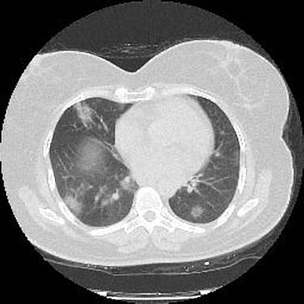 Classical CT at presentation